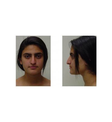 Hanging Tip Rhinoplasty Before